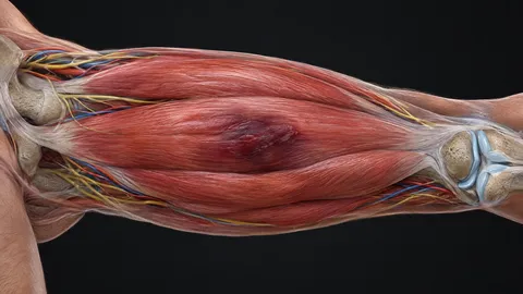 Front of the thigh showing a deep bruise in the quadriceps muscle against the thigh bone