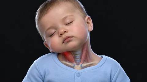 Sleeping baby boy with his head tilted to one side and the tight neck muscle shown on that side