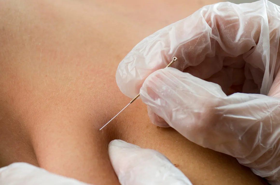 Close-up of a gloved hand placing a dry needle into the skin